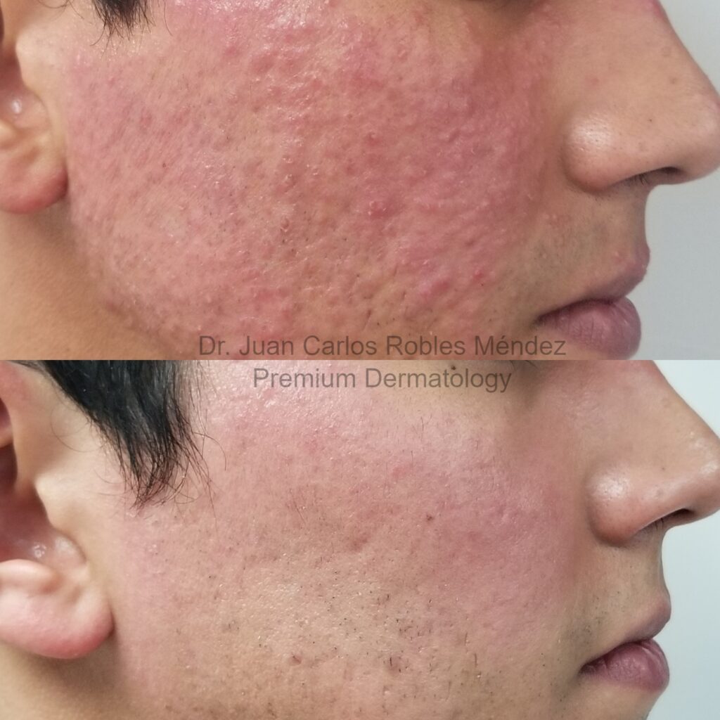 Rosacea-Antes-y-DespuesA